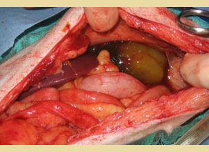 The gallbladder mucocele in dogs