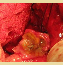 The gallbladder mucocele in dogs