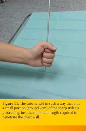 Thoracostomy tube placement