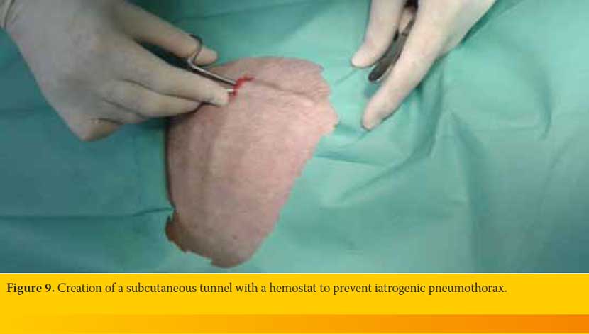 Thoracostomy tube placement