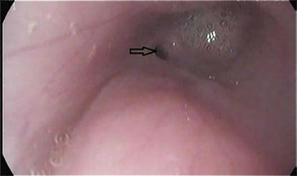 Oesophageal strictures associated with oral antibiotics in cats-a report of three cases