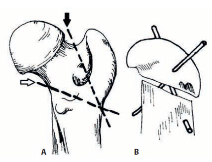 v8i2 femoral head excision img16